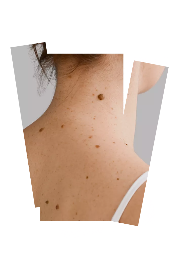 Dra. Lourran Lenci - Cirurgias Dermatológicas